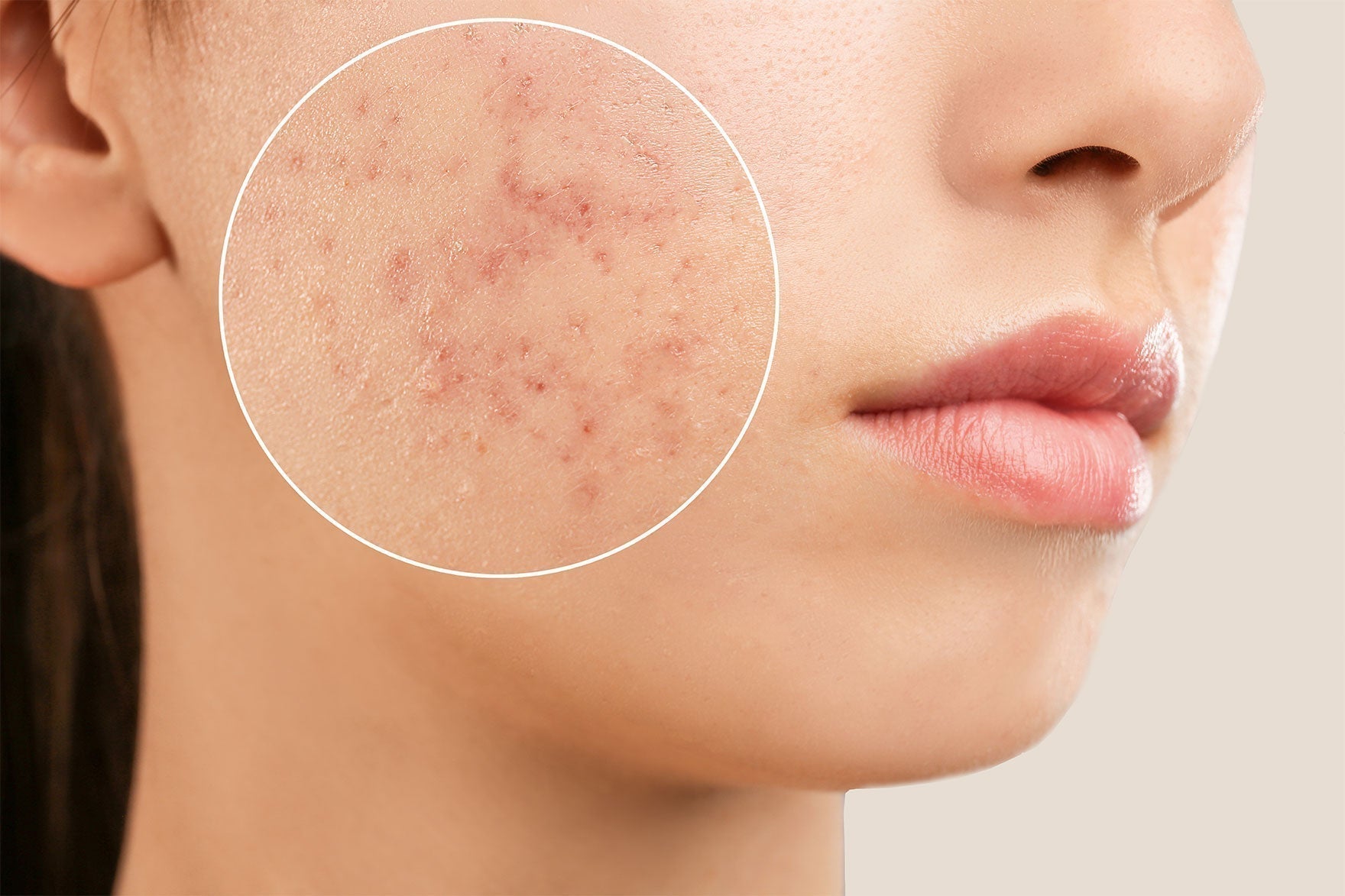 Acné chez l'adulte article Kbeauty cosmetics