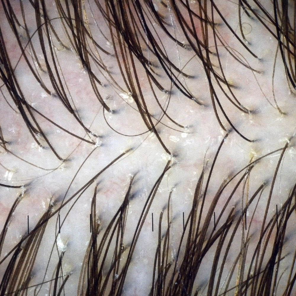 Diagnostic du cuir chevelu